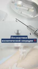 Косметикалық отаның салдары